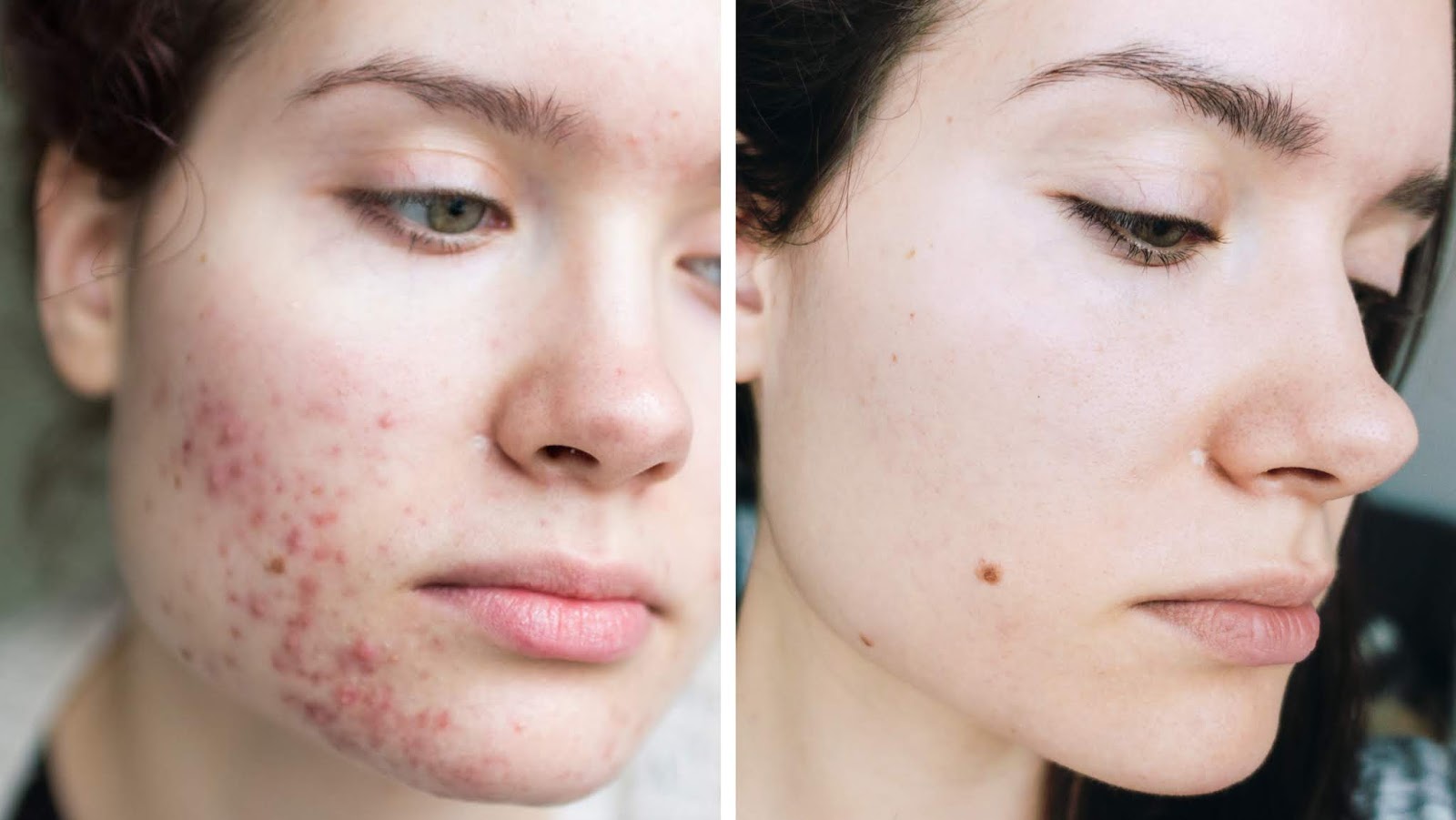 Guide To Develop A Skin Care Routine For Acne Prone Skin Motiza