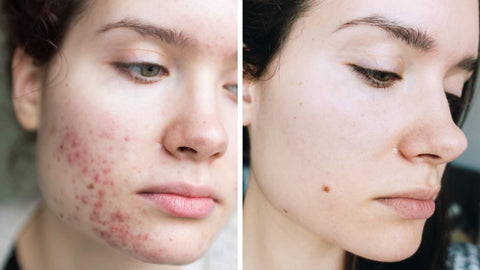 Step-by-Step Guide for Acne-Prone Skin Care Routine